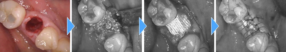 インプラント手術の実施